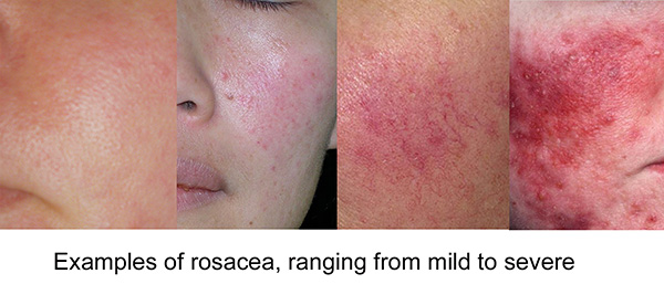 Examples of rosacea